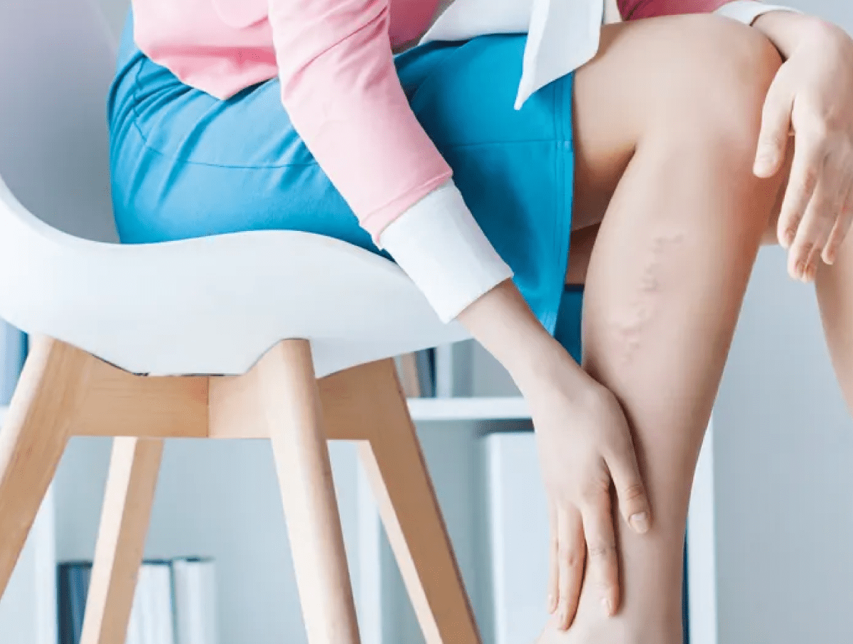 Why Are Women More Susceptible to Varicose Veins?