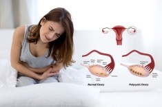 Polycystic Ovaries Polycystic Ovaries