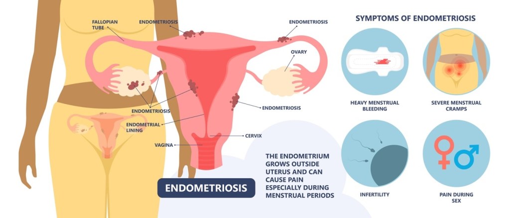 Endometriosis_3