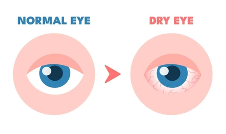 dry-eyes dry-eyes