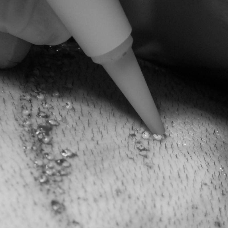 Hair Transplant img_0000_implant