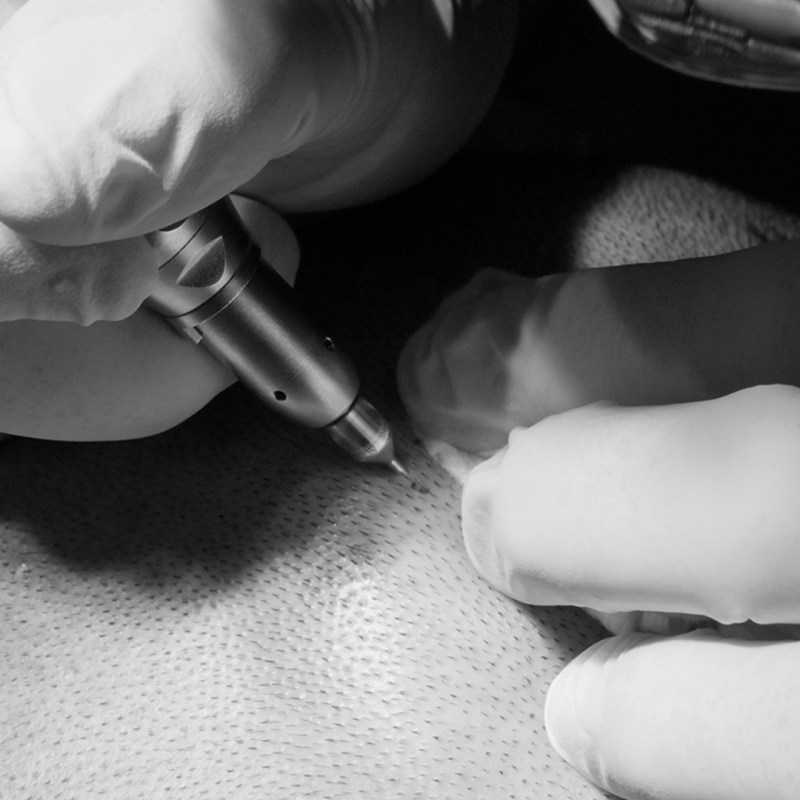 Hair Transplant img_0001_extraction