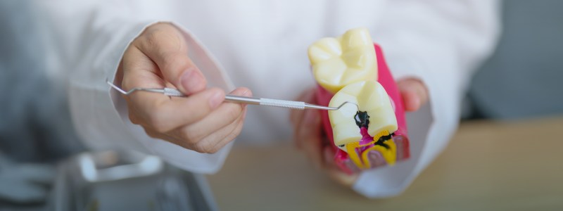 Cavities & Tooth Decay