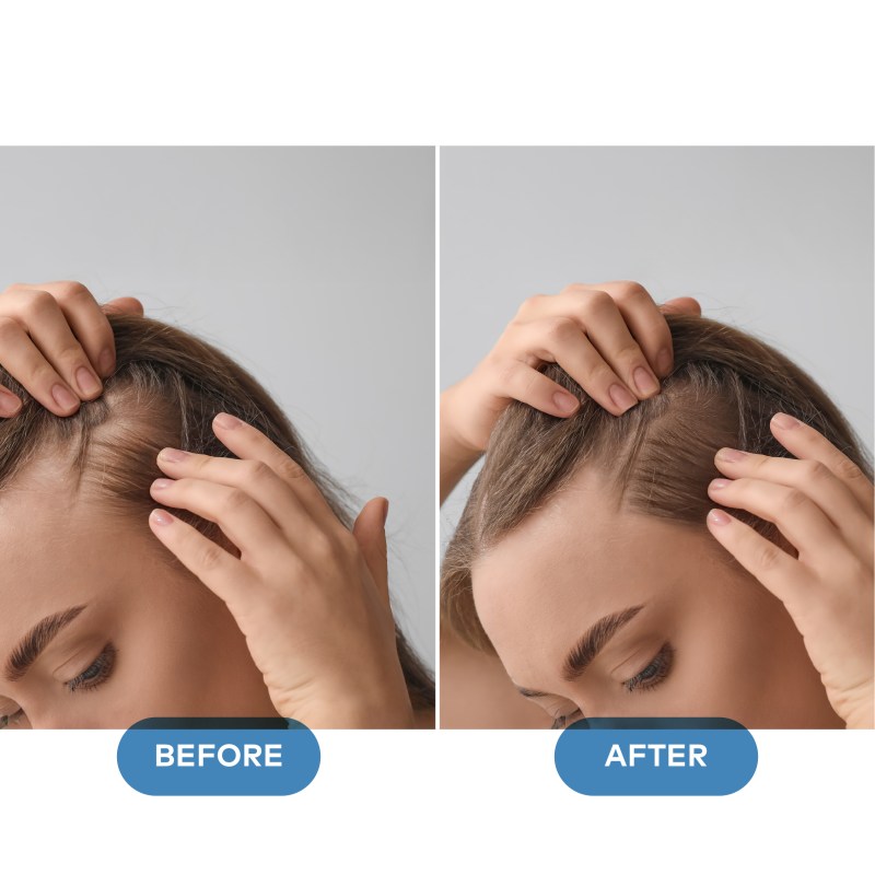 Hair Loss B&A-01