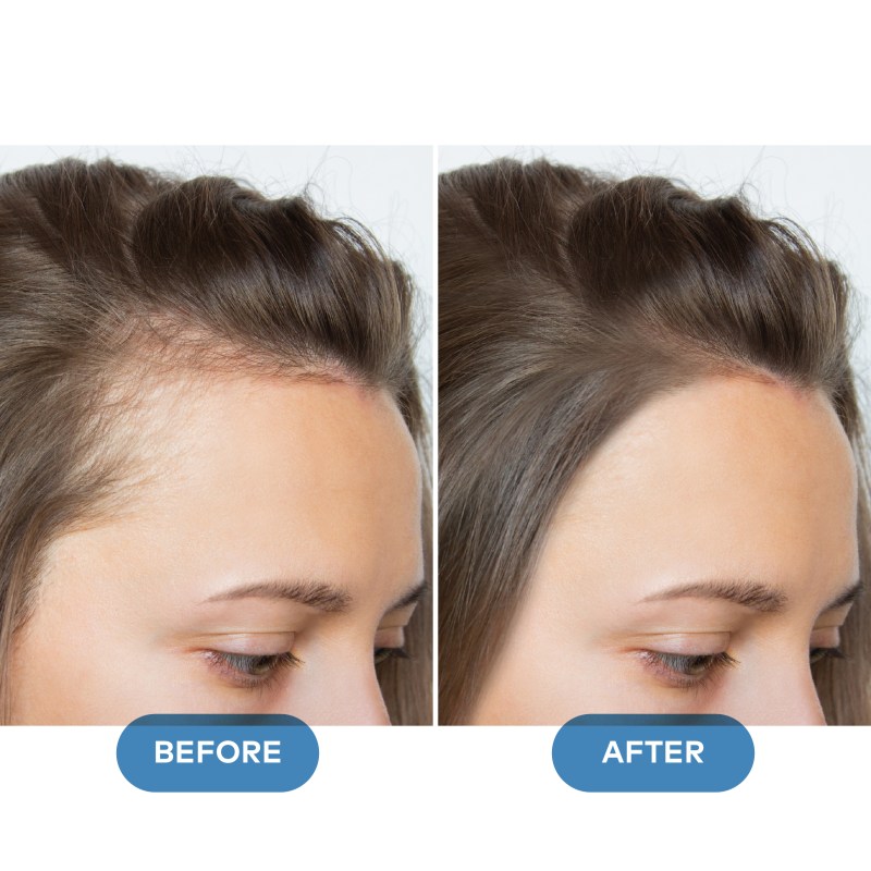 Hair Loss B&A-02