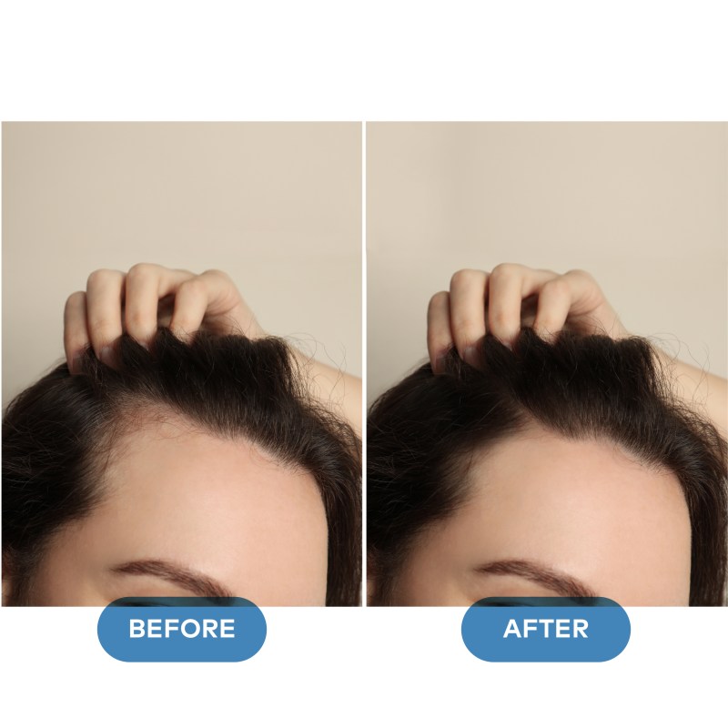 Hair Loss B&A-03