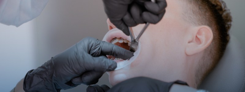 Tooth Extraction