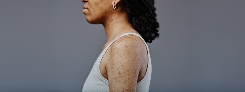 Skin Cancer Detection Treatment and Diagnosis
