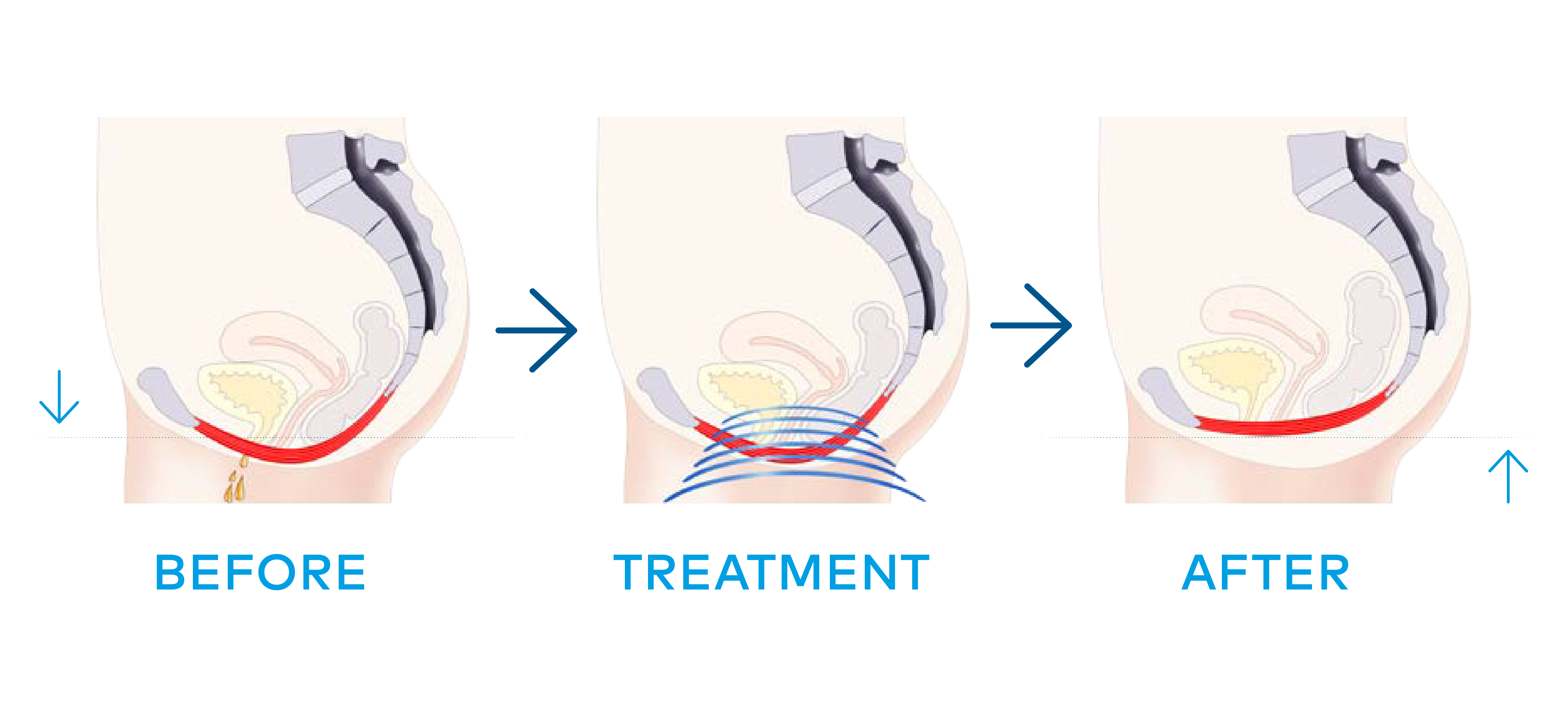 Emsella chair treatment procedure