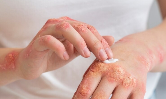 hands-patient-suffering-from-psoriasis_23-2149329646