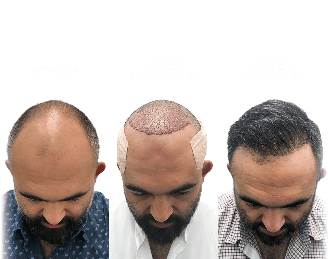 Long Hair Transplant