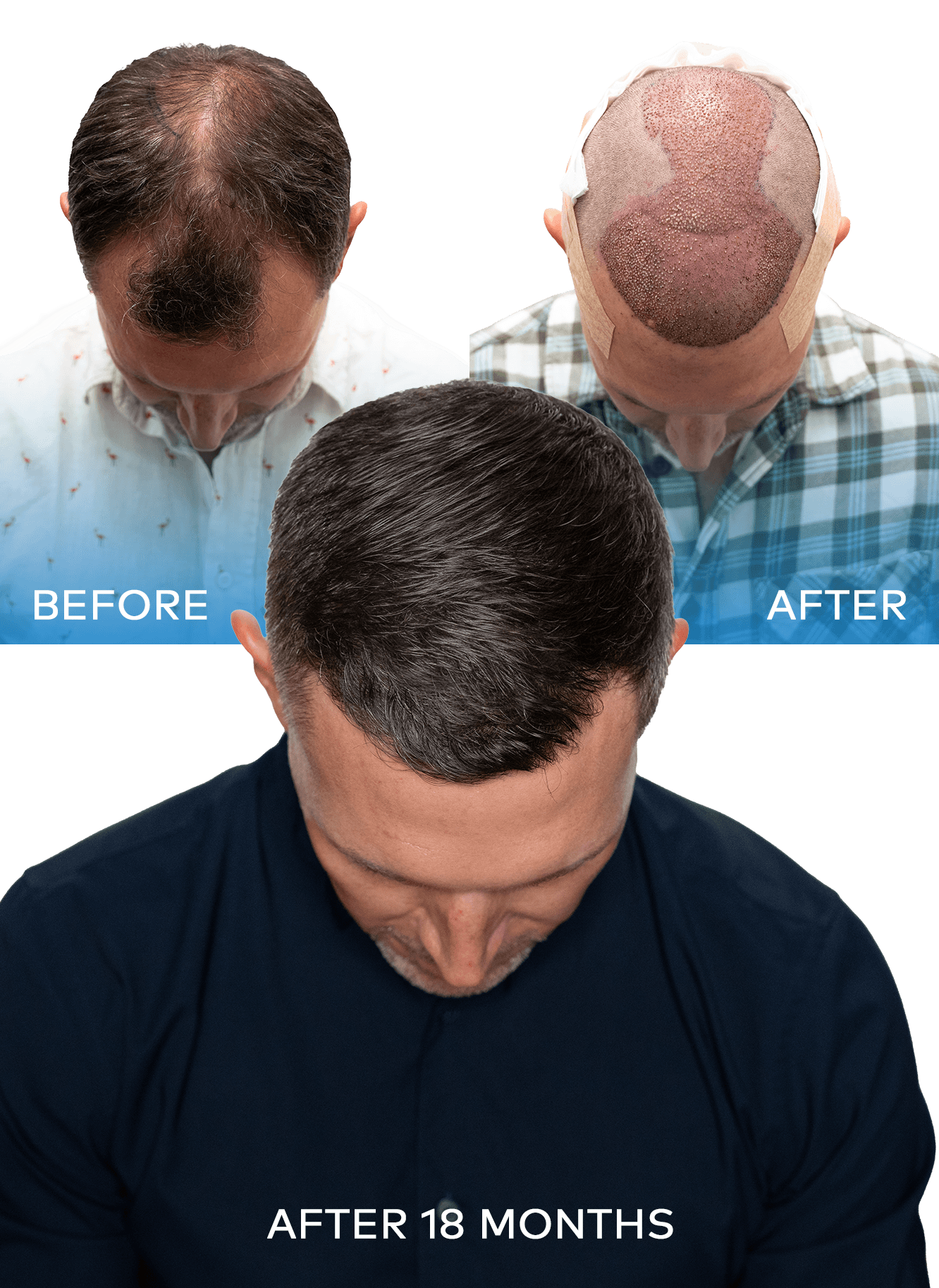 men health hair transplant