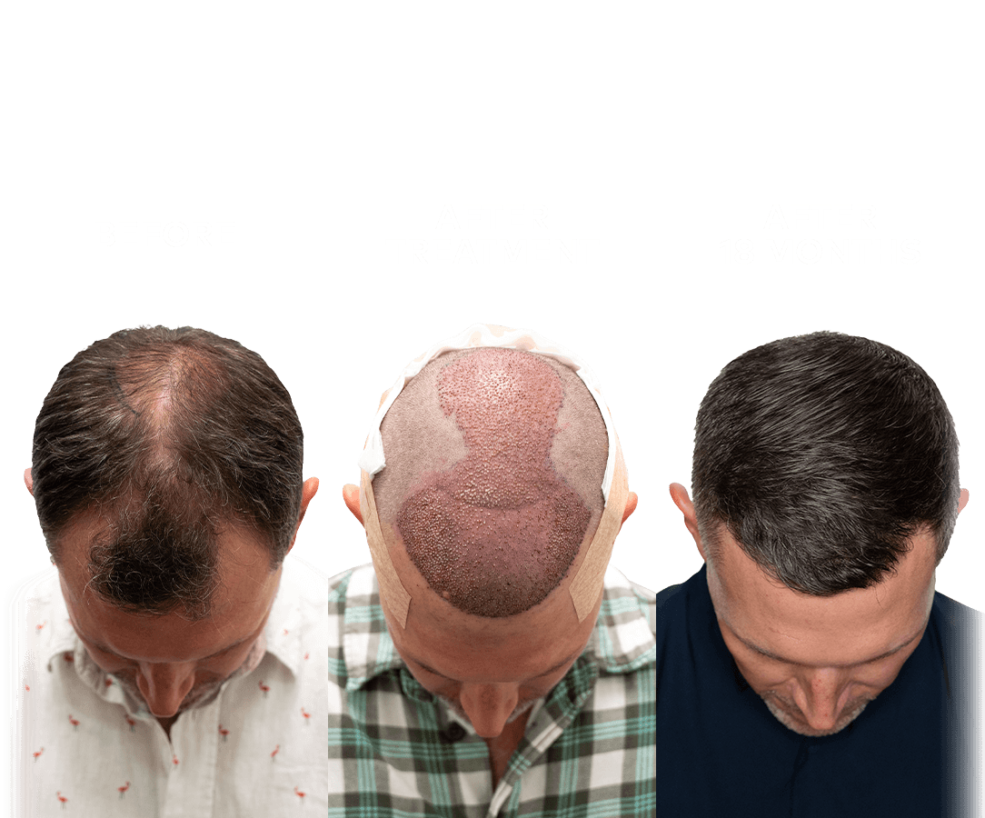 Long Hair Transplant Hair Loss in Dubai